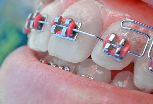 Công nghệ mới niềng răng mắc cài 3m ugsl