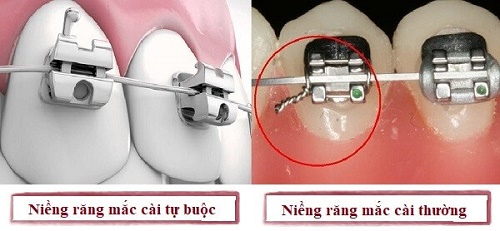Công nghệ mới niềng răng mắc cài 3m ugsl 3