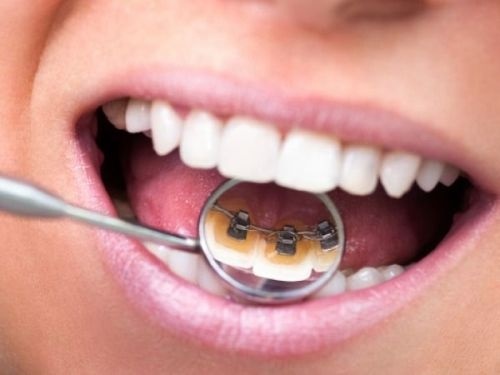 Niềng răng mặt trong giá rẻ cho bạn chọn lựa