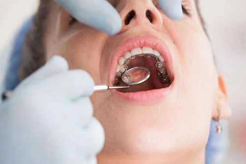 Niềng răng mặt trong giá rẻ cho bạn chọn lựa