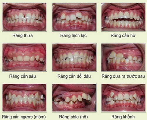 Các dạng niềng răng sai khớp cắn bạn cần biết