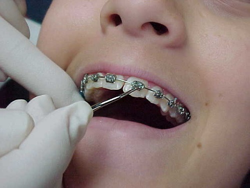 Quá trình niềng răng thưa có đau không?