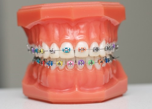 Dịch vụ niềng răng trả góp tphcm có nha khoa nào thực hiện không