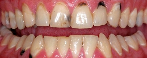 Răng bị đen phải làm sao? Nguyên nhân răng đen ở trẻ em và người lớn 1