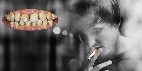 Răng bị đen phải làm sao? Nguyên nhân răng đen ở trẻ em và người lớn 2
