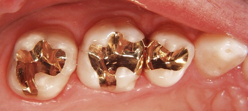 Trám răng mất thời gian bao lâu là xong? 3 điều cần lưu ý sau khi trám răng 2