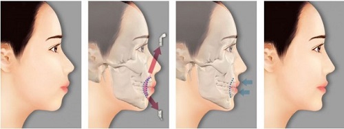 Giải pháp mới chữa răng hô không cần niềng bạn biết chưa