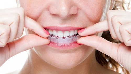 Bác sĩ tư vấn - Niềng răng bao lâu thì nên có bầu?