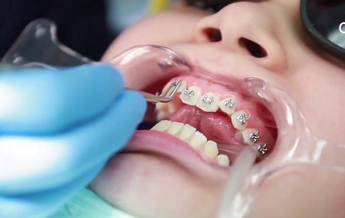 Điều trị niềng răng bị hở lợi nhanh chóng cho bạn