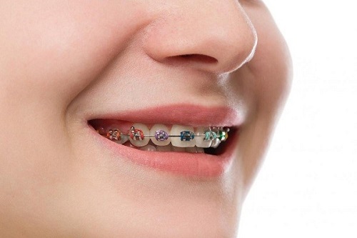 Điều trị niềng răng bị hở lợi nhanh chóng cho bạn-3 Điều trị niềng răng bị hở lợi nhanh chóng cho bạn