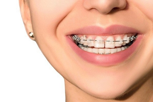 Niềng răng bị hỏng có cách nào để khắc phục không?