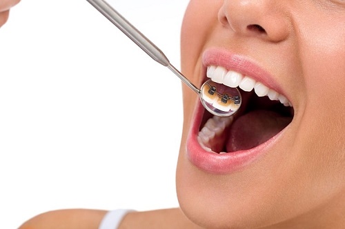Niềng răng bị hỏng có cách nào để khắc phục không? 1