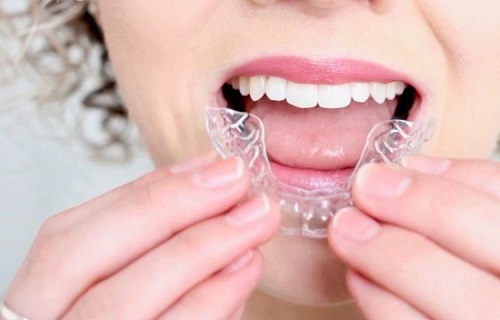 Niềng răng bị hỏng có cách nào để khắc phục không?
