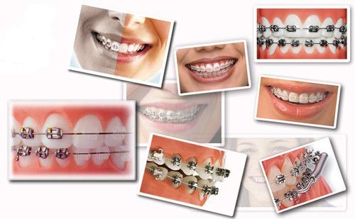 Nguyên nhân và cách khắc phục tình trạng niềng răng bị hóp má