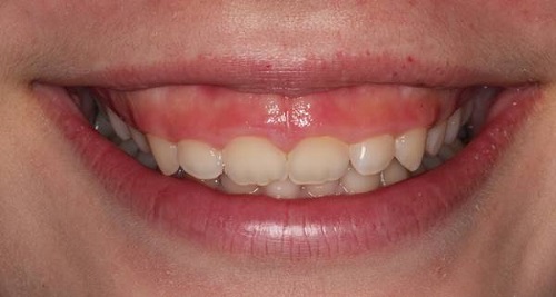 Niềng răng chữa cười hở lợi hiệu quả không?