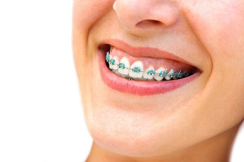Niềng răng chữa cười hở lợi hiệu quả không?