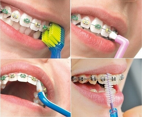 Cách chữa niềng răng gây hôi miệng cho bạn
