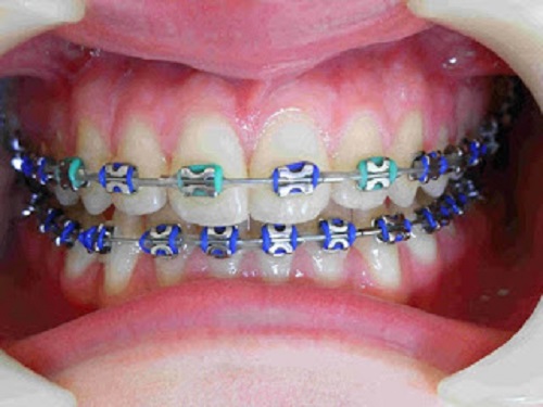 Niềng răng giai đoạn nào đau nhất? Cần làm gì để giảm đau