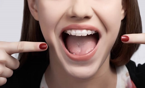 Niềng răng hàm trên mất bao lâu là có kết quả? 3