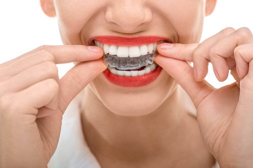 Niềng răng tháo lắp có tốt không? Đánh giá từ chuyên gia và khách hàng