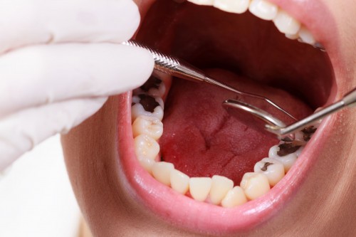 Trám răng không nên ăn gì để có kết quả tốt? 2