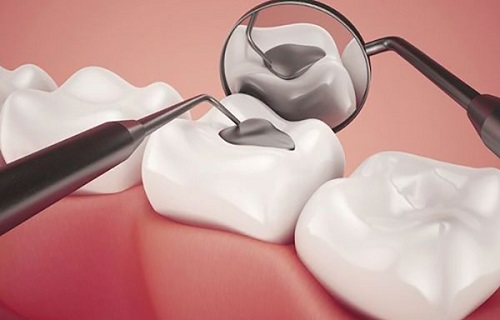 Trám răng loại nào tốt nhất hiện nay? Nhờ bác sĩ tư vấn 3