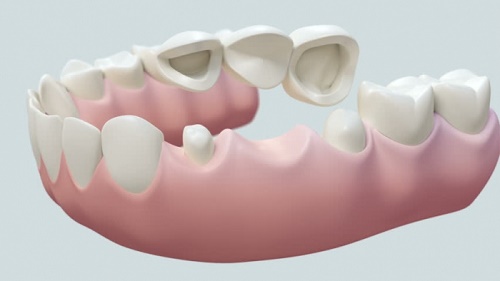 Trồng răng bằng cầu răng thực hiện như thế nào? 1