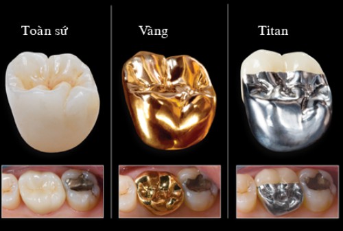 Trồng răng bao nhiêu tiền 1 cái là thực hiện được? 3