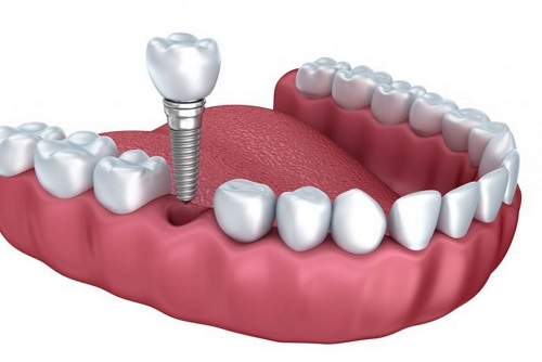 Trồng răng có ảnh hưởng gì không? Cần tìm hiểu thêm 2 Trồng răng có ảnh hưởng gì không? Cần tìm hiểu thêm 2