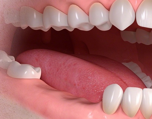 Trồng răng cối bằng implant - Được thực hiện như thế nào? 1
