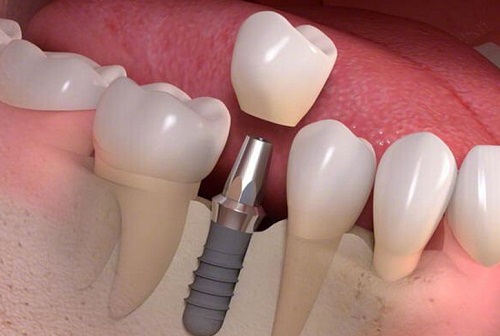 Trồng răng cối bằng implant - Được thực hiện như thế nào? 2