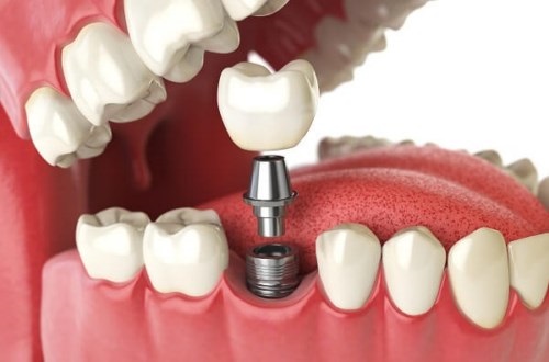 Trồng răng cối bằng implant - Được thực hiện như thế nào? 3