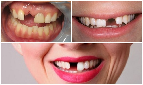 Quy trình thực hiện trồng răng cửa hàm trên cho bạn 1