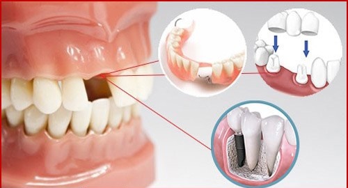 Quy trình thực hiện trồng răng cửa hàm trên cho bạn 2