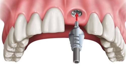 Quy trình thực hiện trồng răng cửa hàm trên cho bạn 4