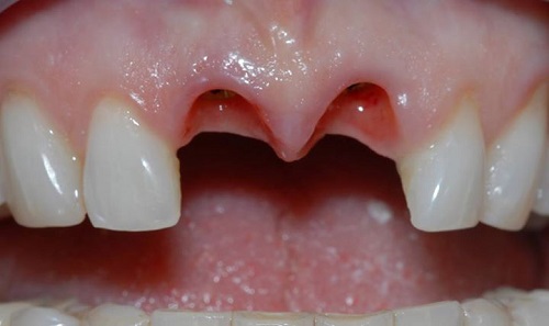 Trồng răng cửa mất bao lâu là thực hiện xong? 1