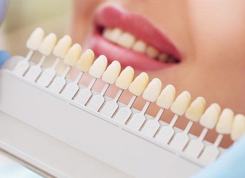 Làm răng sứ cả hàm cần lưu ý điều gì-1 Làm răng sứ cả hàm cần lưu ý điều gì