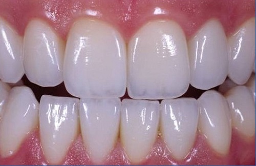 Làm răng sứ có đau không? Cần kiêng gì trước khi làm răng