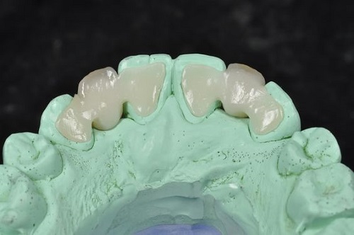 Làm răng sứ mất bao lâu thì có hàm răng đẹp