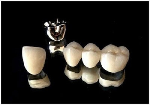 Làm răng sứ thẩm mỹ loại nào tốt và hiệu quả lâu dài?