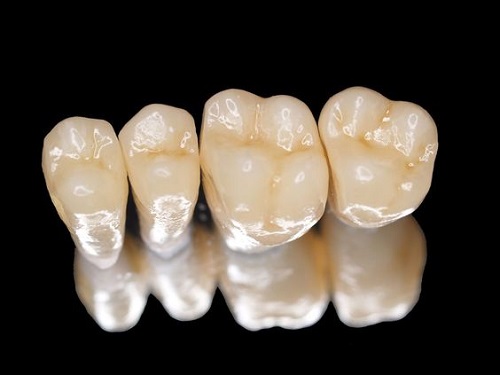 Làm răng sứ thẩm mỹ loại nào tốt và hiệu quả lâu dài?