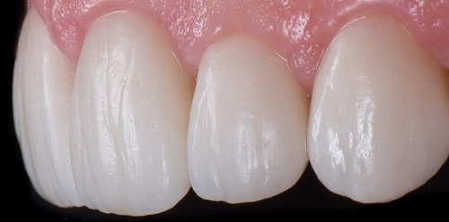 Lắp răng sứ bị sưng lợi - Nguyên nhân và cách khắc phục