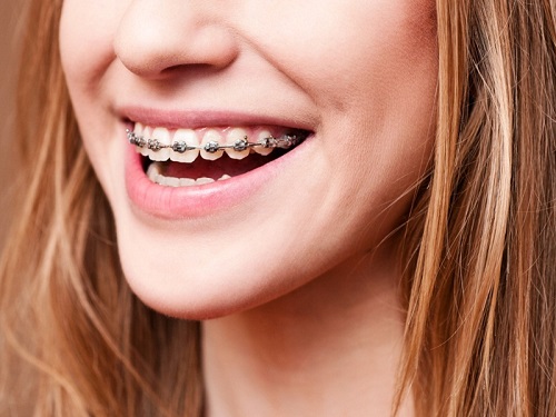 Niềng răng lệch hàm - Giải pháp thẩm mỹ cho bạn