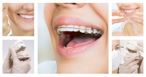 Niềng răng phải đeo hàm duy trì bao lâu? Các nguyên tắc cần lưu ý