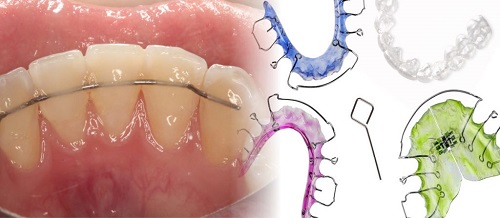 Niềng răng phải đeo hàm duy trì bao lâu? Các nguyên tắc cần lưu ý-3 Niềng răng phải đeo hàm duy trì bao lâu? Các nguyên tắc cần lưu ý