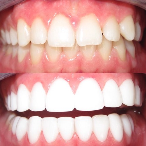 Những điều cần biết về răng sứ ceramill-1 Những điều cần biết về răng sứ ceramill