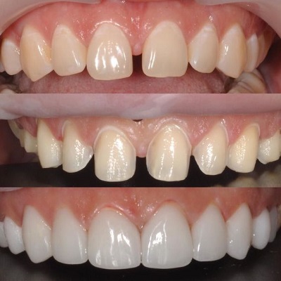 Những điều cần biết về răng sứ ceramill