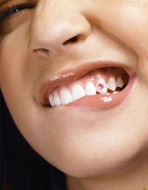 Răng sứ có đính đá được không? Thông tin chính xác từ nha khoa