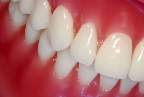 Chuyên gia tư vấn: Lắp răng sứ có tháo ra được không?