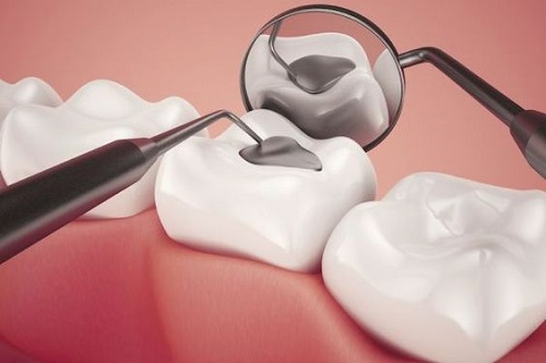 Răng sứ có trám được không? Cách khắc phục hiệu quả